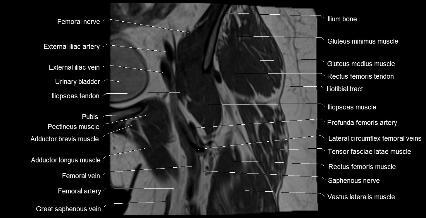MRI Hip 3T coronal cross sectional anatomy image 15.webp